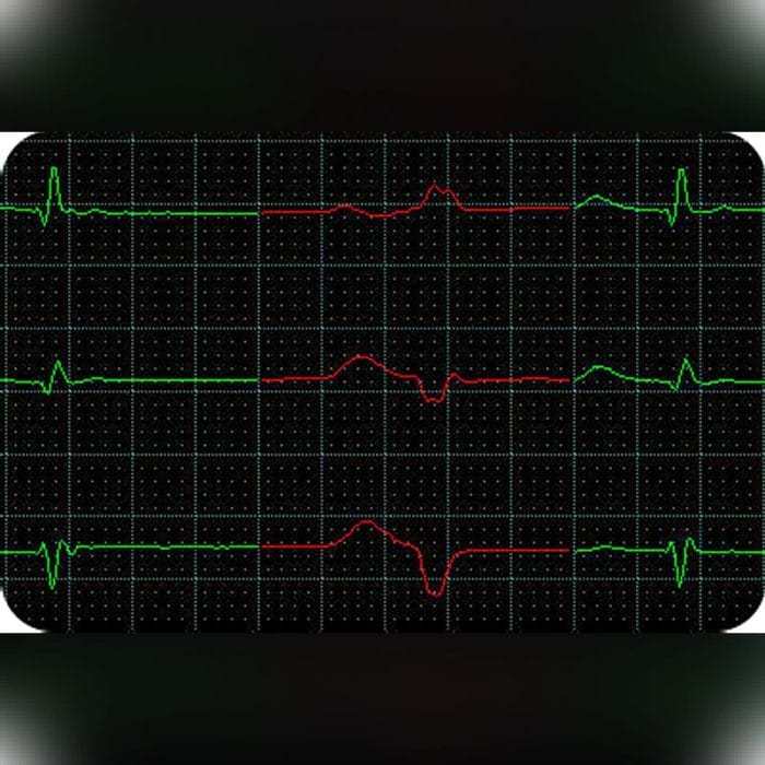 3-Channel Holter Monitor 1