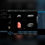 3D/4D Ultrasound System 6