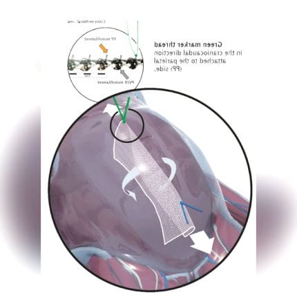 Abdominal Hernia Prosthesis 1