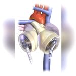 Adult Artificial Heart 2