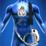 Adult Artificial Heart 3