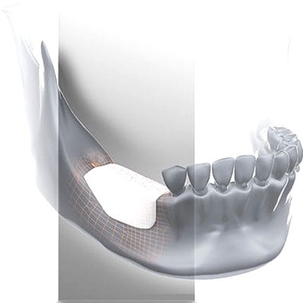 Allograft Bone Substitute