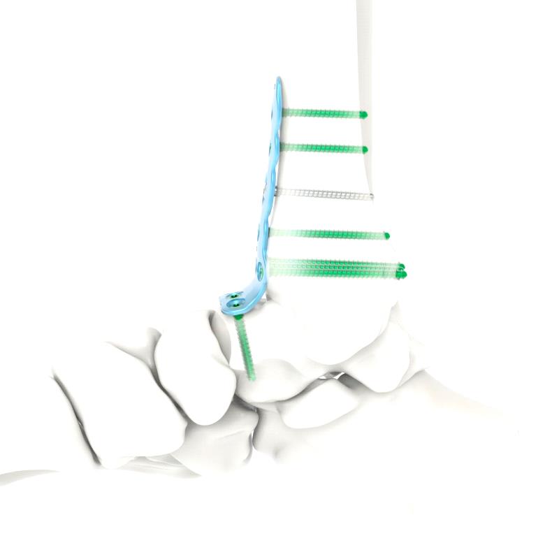 Ankle Arthrodesis Plate 1
