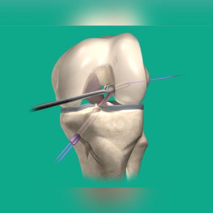 Anterior Cruciate Ligament Interference Screw 2