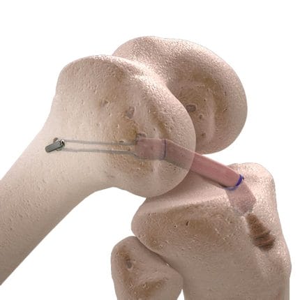 Anterior Cruciate Ligament Ligament Prosthesis