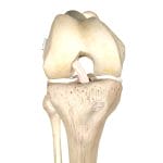 Anterior Cruciate Ligament Ligament Prosthesis