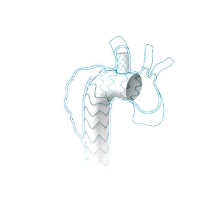 Aortic Arch Stent Graft