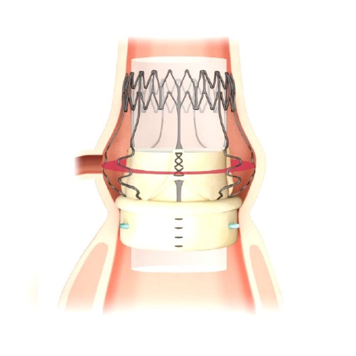 Aortic Valve Bioprosthesis 4