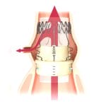 Aortic Valve Bioprosthesis 5