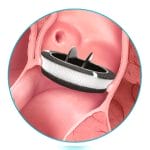 Aortic Valve Prosthesis 2