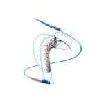 Ascending Thoracic Aorta Stent Graft