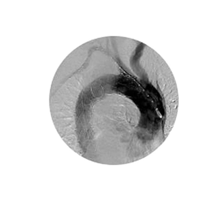 Ascending Thoracic Aorta Stent Graft 2