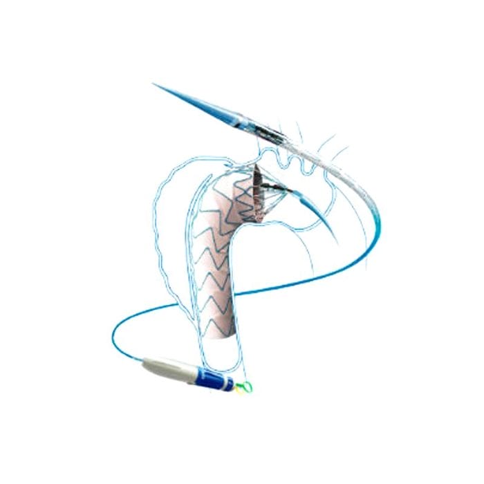 Ascending Thoracic Aorta Stent Graft