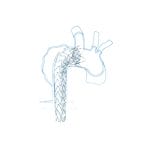 Ascending Thoracic Aorta Stent Graft