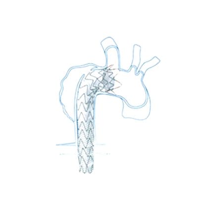 Ascending Thoracic Aorta Stent Graft