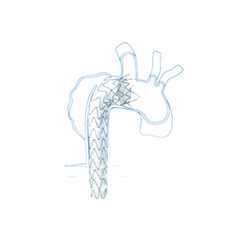 Ascending Thoracic Aorta Stent Graft