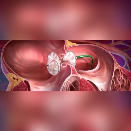 Atrial Septal Closure Occlusion Device 1