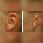 Auricular Cosmetic Prosthesis 5