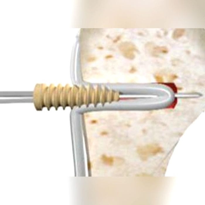 Biceps Tendon Suture Anchor 3