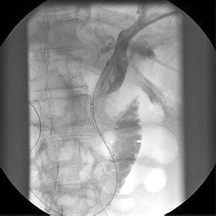 Biliary Stent 1