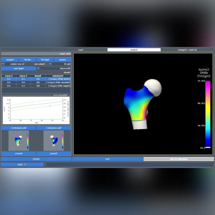 Bone Densitometry Software 2