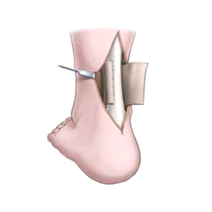 Calcaneal Tendon Ligament Prosthesis 3