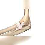 Calcaneal Tendon Suture Anchor 1