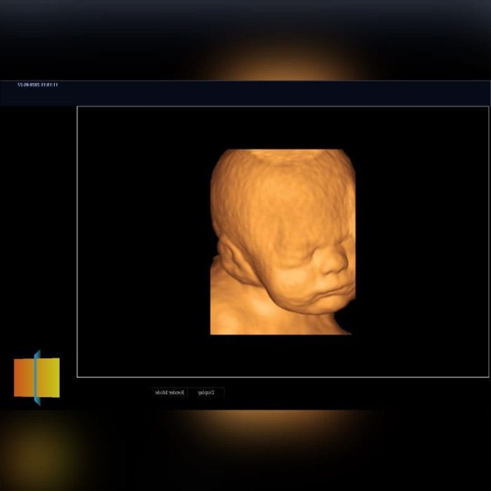 Cardiovascular Ultrasound Imaging System 6