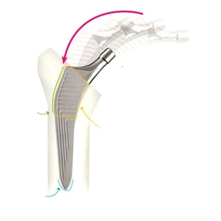 Cemented Or Non-Cemented Femoral Stem 1