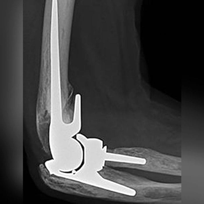 Cemented Total Elbow Prosthesis 2