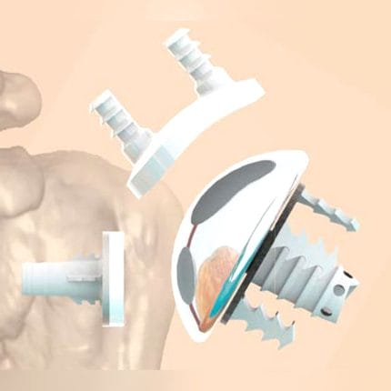 Cementless Humeral Head Prosthesis 1