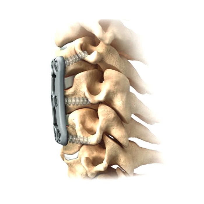 Cervical Arthrodesis Plate 1