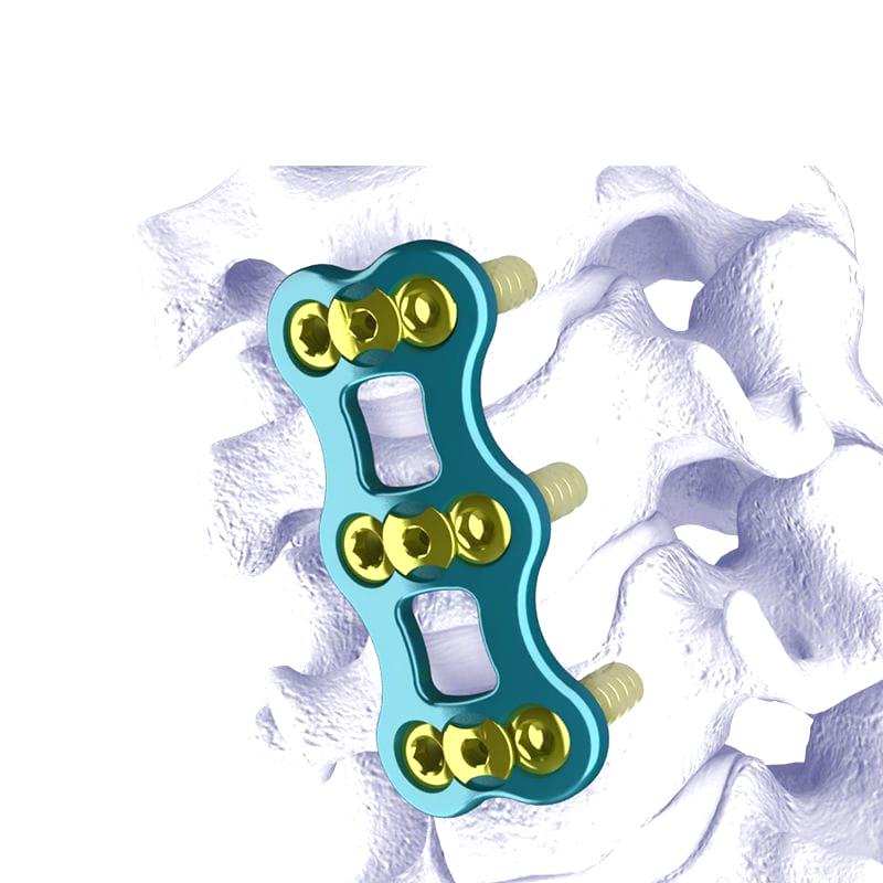 Cervical Arthrodesis Plate 1