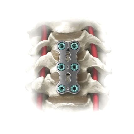 Cervical Arthrodesis Plate 1