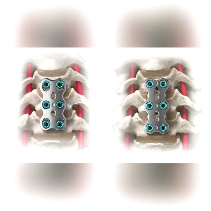 Cervical Arthrodesis Plate 2