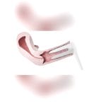 Cervical Dilator 1