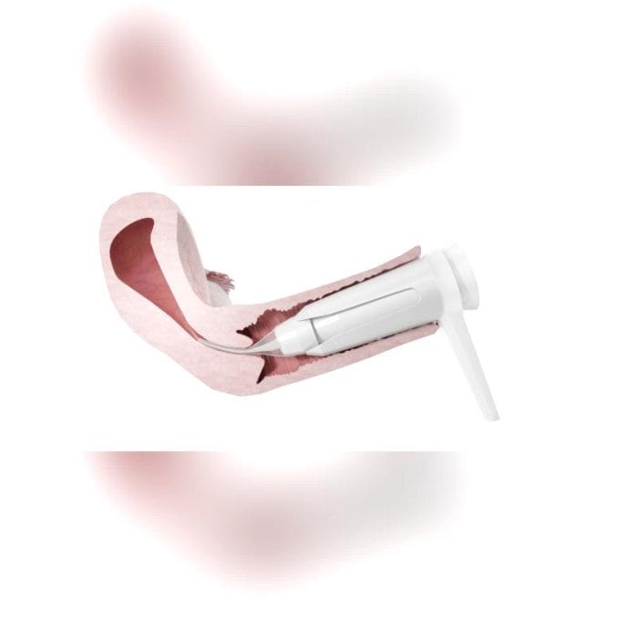 Cervical Dilator 2