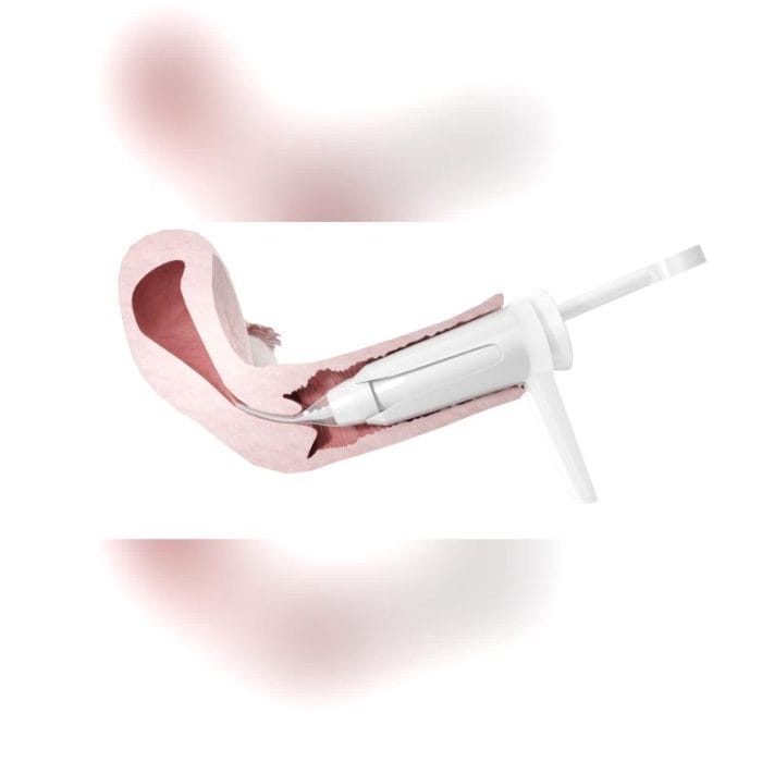 Cervical Dilator 4