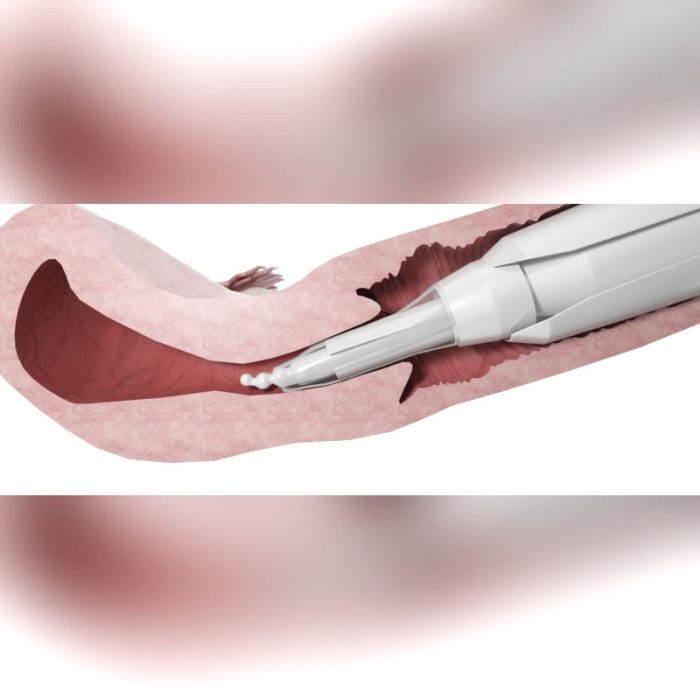 Cervical Dilator 5