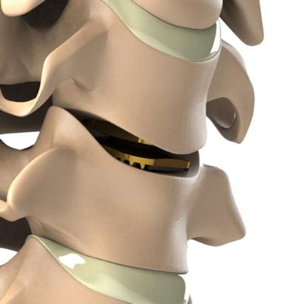 Cervical Disc Prosthesis 1