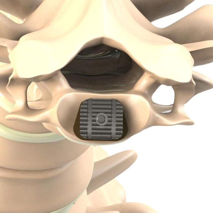 Cervical Disc Prosthesis 4