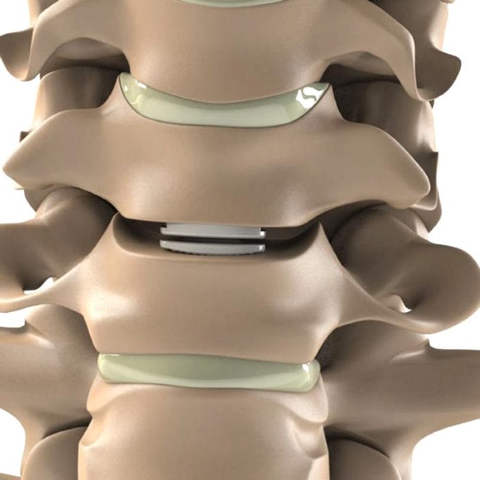 Cervical Disc Prosthesis 5