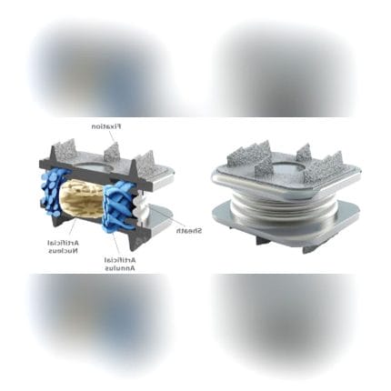 Cervical Disc Prosthesis 1