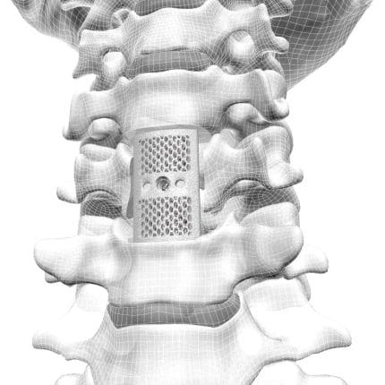 Cervical Vertebral Corpectomy Prosthesis