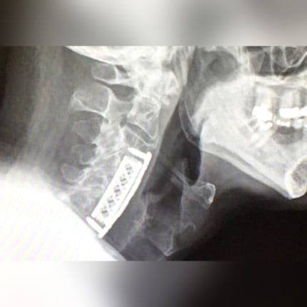 Cervical Vertebral Corpectomy Prosthesis 1