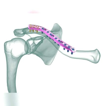 Clavicle Compression Plate 1