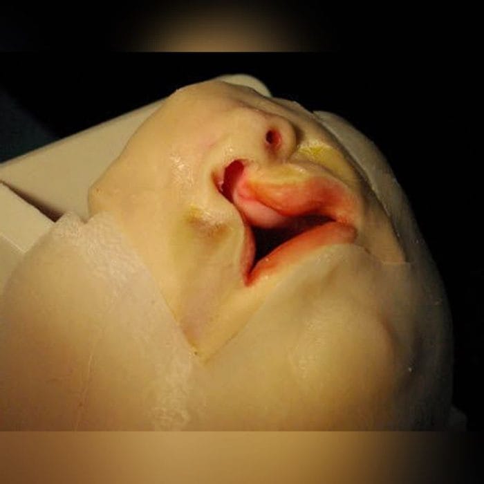 Cleft Lip Surgery Simulator