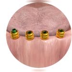 Conical Dental Implant 3