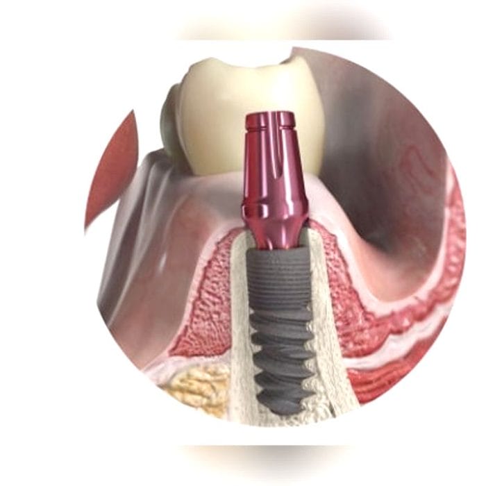 Conical Dental Implant 4