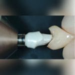 Conical Dental Implant 7